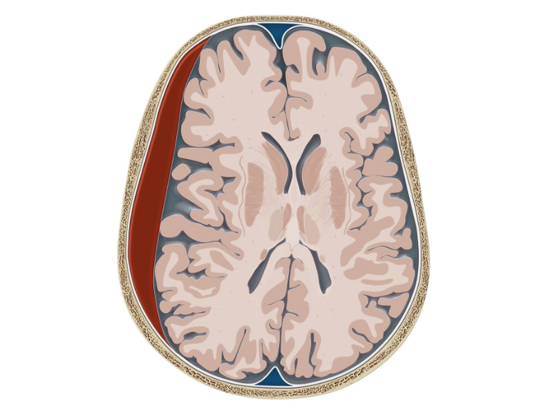 Illustration Subduralhämatom